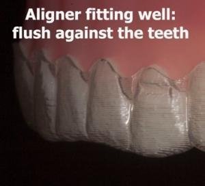 Invisalign fitting well