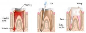Root canal explained diagram