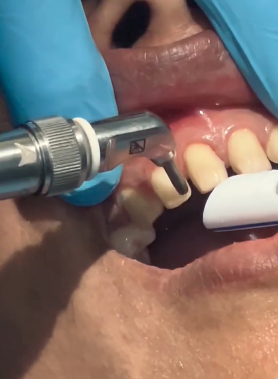 Before veneers – natural smile before treatment in Richmond