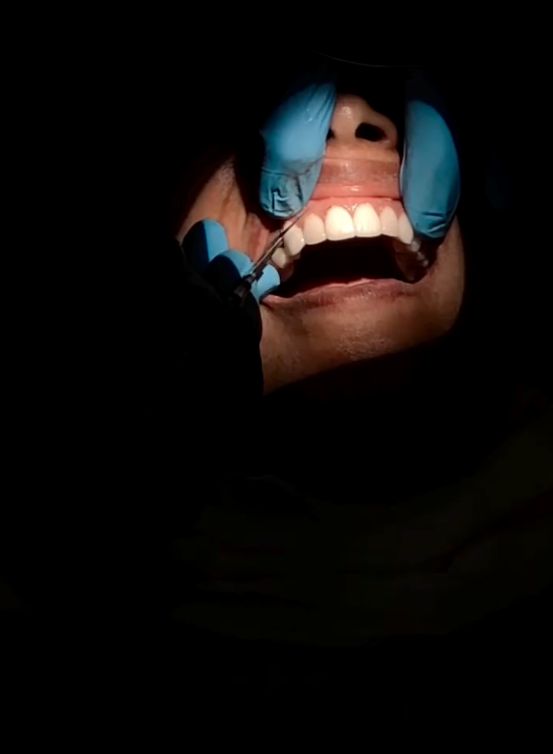 Porcelain veneers in Richmond – clinical view during procedure