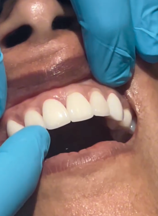 After porcelain veneers – smile transformation at The Richmond Dentist