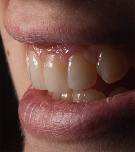 Cosmetic bonding results