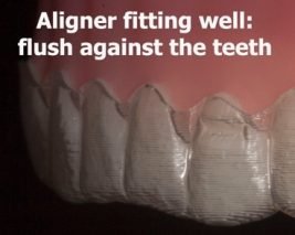 Invisalign fitting well