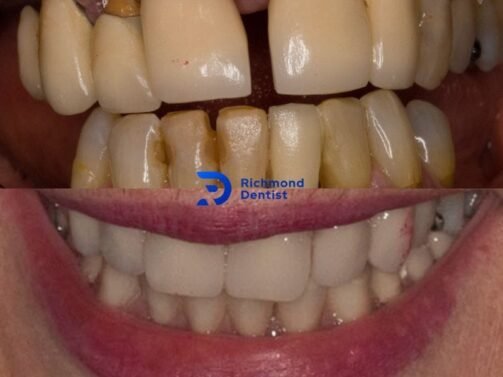 before and after photo with dental implants in Richmond London