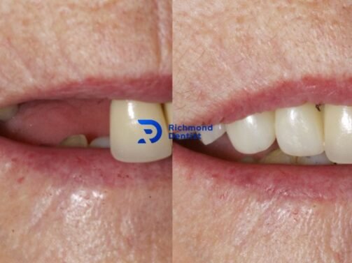 photo with dental implants treatment in Richmond, London before and after