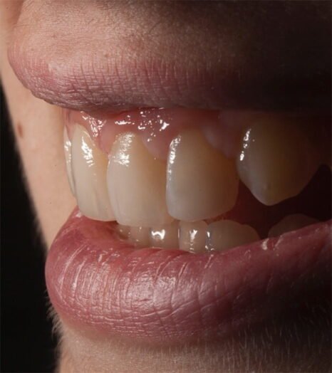 Cosmetic bonding results