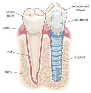 Dental implants diagram