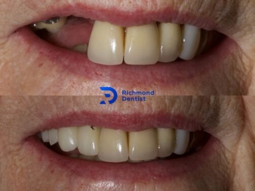 photo showing how dental implants look before and after the treatment in Richmond, London