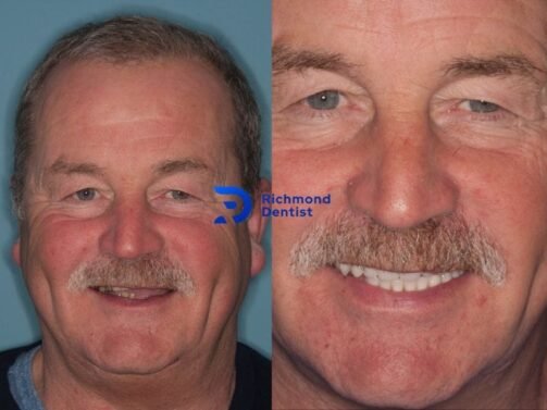 before and after photo of our patient with dental implants in Richmond London
