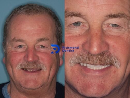 before and after photo of our patient with dental implants in Richmond London