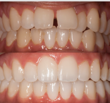 Close-up comparison of teeth before Invisalign treatment with visible gaps and crooked alignment (top), and after treatment with perfectly aligned, straight teeth (bottom).