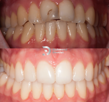 Close-up of teeth before composite bonding with visible chips, discolouration, and damage (top), and after treatment with a clean, white, and even smile (bottom) by The Richmond Dentist.