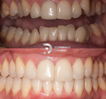 Composite bonding transformation showing damaged and stained teeth before treatment (top) and a fully restored, polished, and symmetrical smile after treatment (bottom) by The Richmond Dentist.