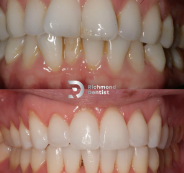 Before and after images showing chipped, stained teeth (top) and the restored, smooth, and white teeth after composite bonding treatment (bottom) by The Richmond Dentist.