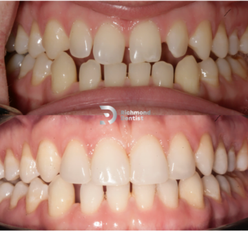 Close-up comparison of teeth before orthodontic treatment with noticeable gaps and crooked teeth (top) and after treatment showing straight, well-aligned teeth (bottom) with the The Richmond Dentist logo.