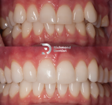 Before and after images of a patient’s teeth showing misalignment and crowding (top) and straight, properly aligned teeth after orthodontic treatment (bottom) by The Richmond Dentist.