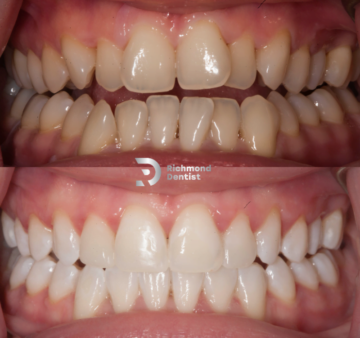 Close-up of a patient’s teeth before orthodontic treatment, showing misalignment (top), and the final result with straightened, aligned and whitened teeth (bottom) by Richmond Dentist.