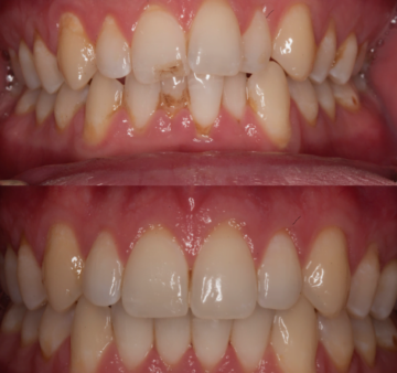Before and after dental treatment showing stained and chipped front teeth (top) and restored, clean, and aligned teeth after treatment (bottom).
