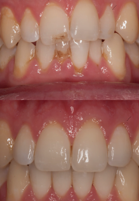 Before and after dental treatment showing stained and chipped front teeth (top) and restored, clean, and aligned teeth after treatment (bottom).