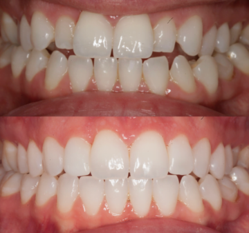 Before and after images of a patient’s teeth showing misaligned teeth with gaps (top) and straightened, properly aligned teeth after orthodontic treatment (bottom).