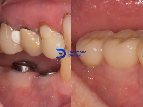 photo with dental implants, before and after treatment in Richmond, London
