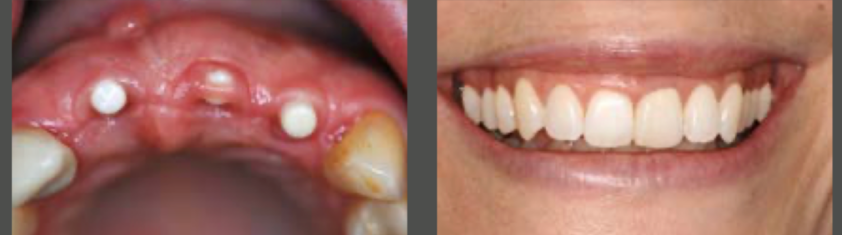 Before and after showing zirconia dental implants placed in the upper jaw (left) and the final result with natural-looking dental crowns and a restored smile (right).